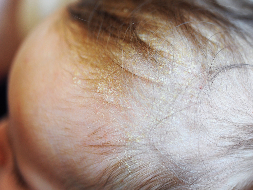 head of baby with light colored dry flakes