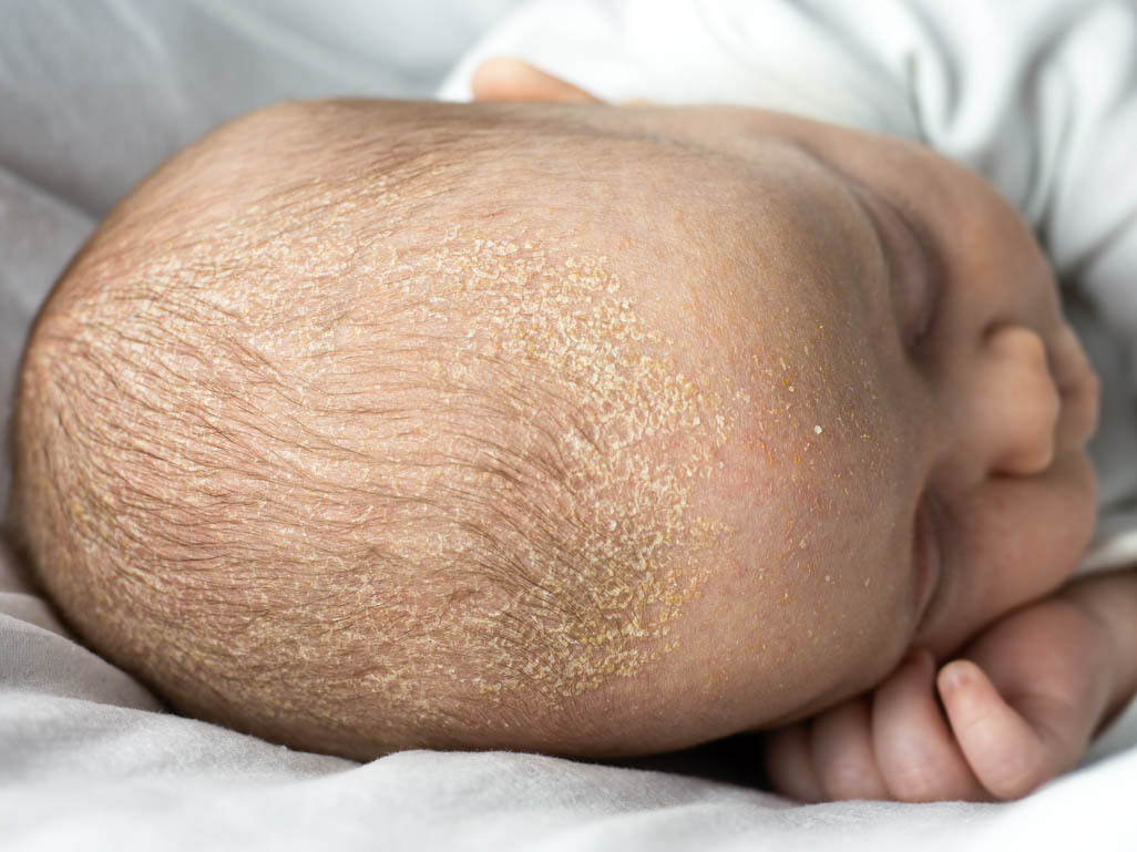 The top of a baby's head who has cradle cap, the text reads: BabyCenter Answers, What is cradle cap?