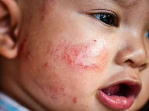 A close-up of a baby's cheek with symptoms of eczema, text reads: BabyCenter Answers, Eczema in babies