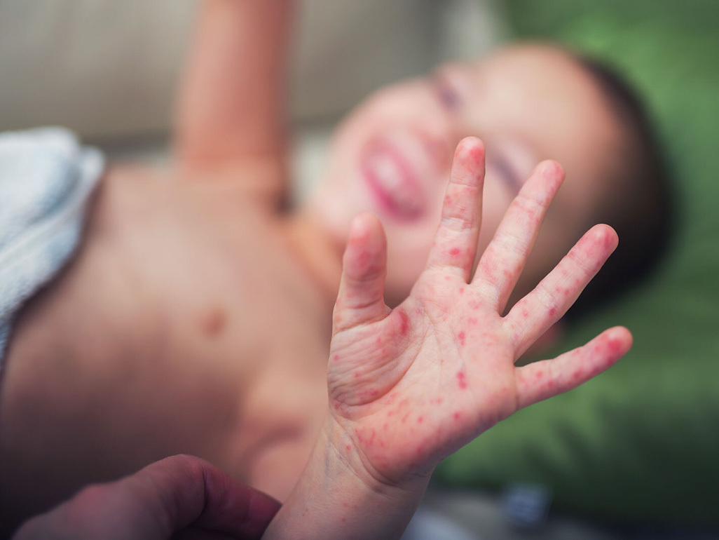 A baby's hand showing symptoms of hand, foot, and mouth disease, text reads: BabyCenter Answers, Hand, foot, and mouth disease