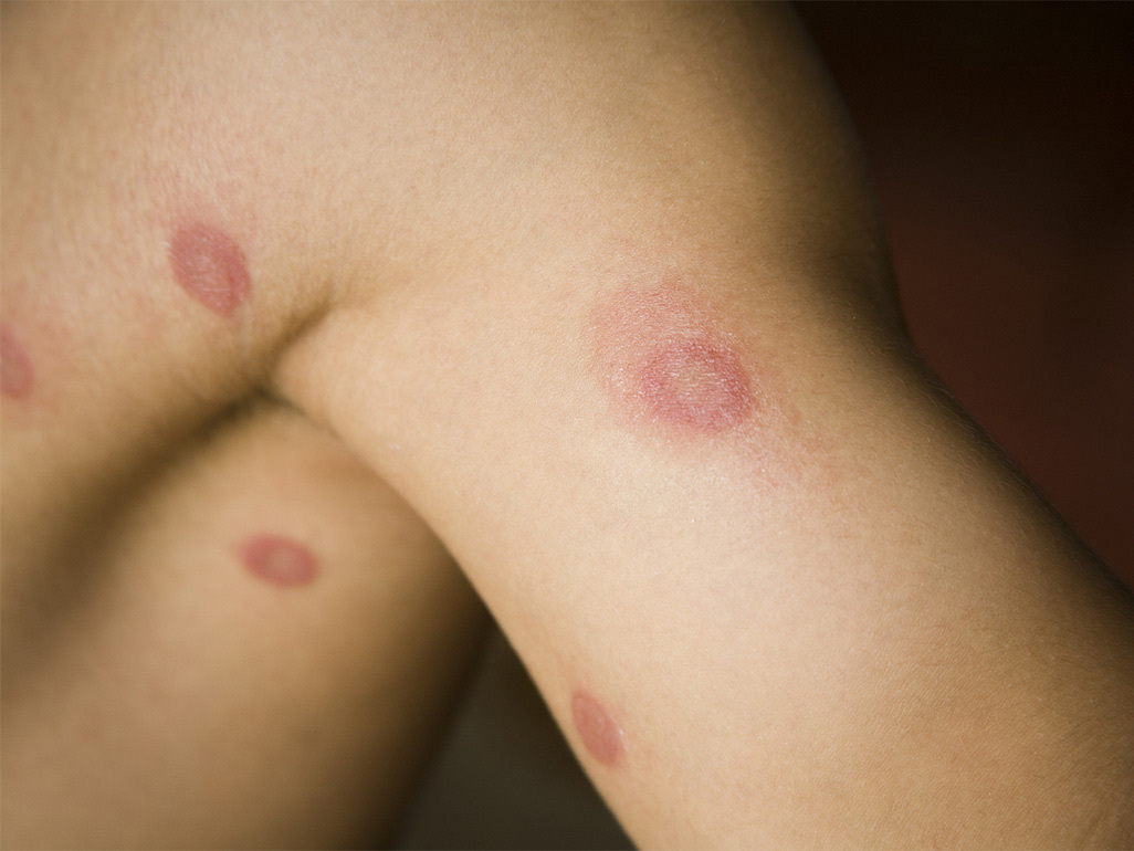 A child with several ringworm patches on their arm and torso