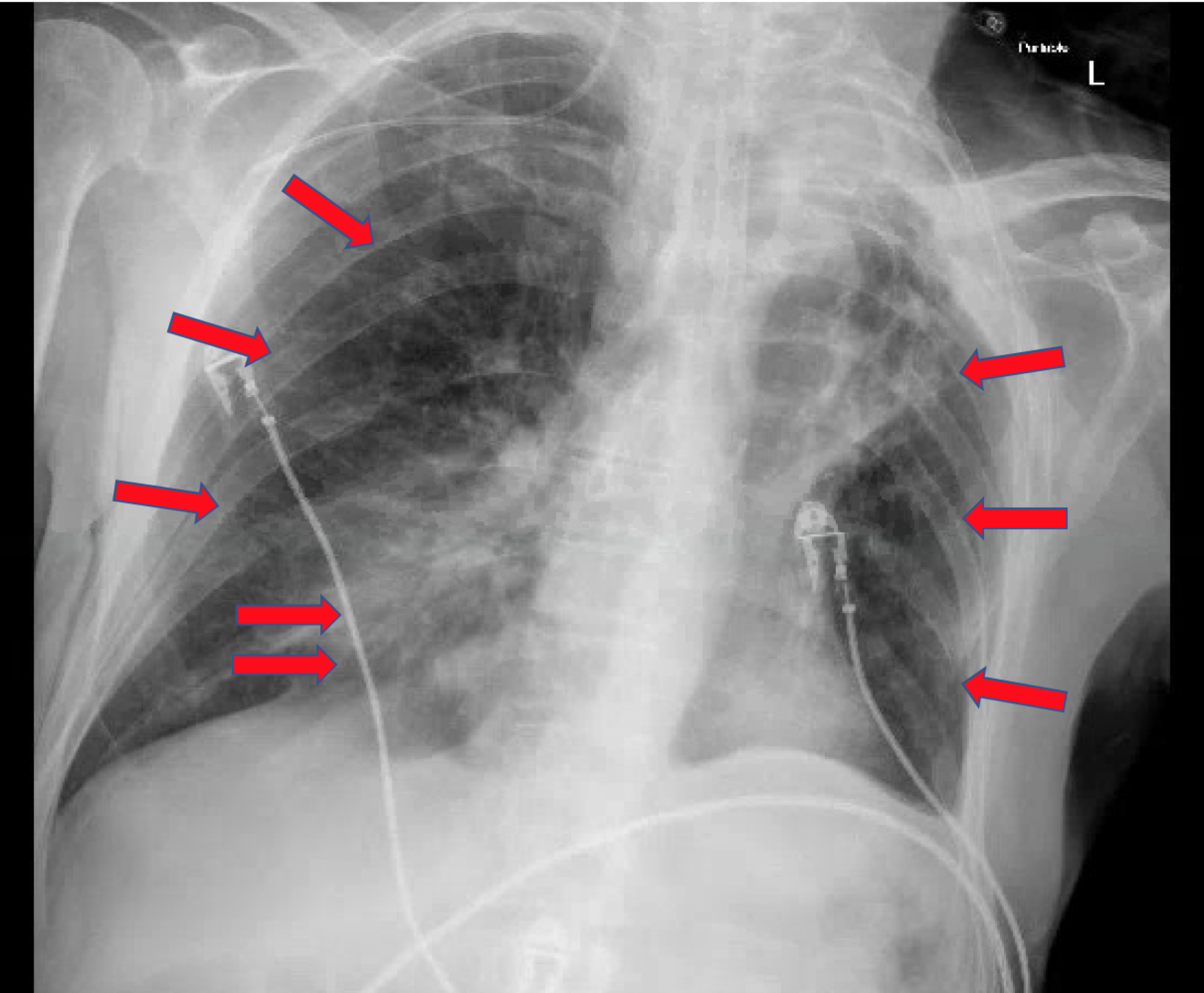 Acute Chest Syndrome X Ray Captions More - vrogue.co