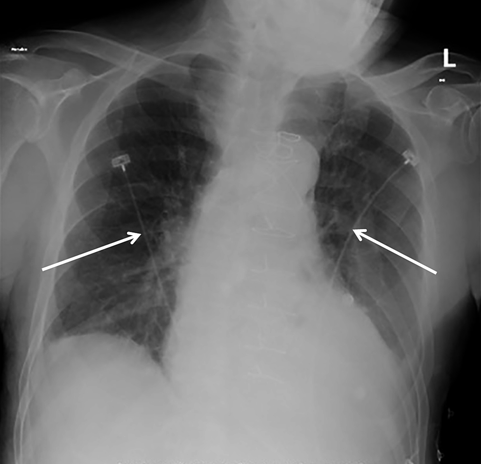 Cureus | Optimizing Computed Tomography for Detection of Pulmonary ...