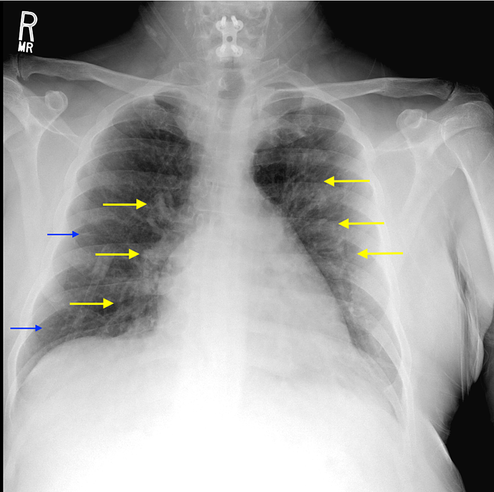 Cureus | The Pulmonary Complications of Paraneoplastic Autoimmune ...