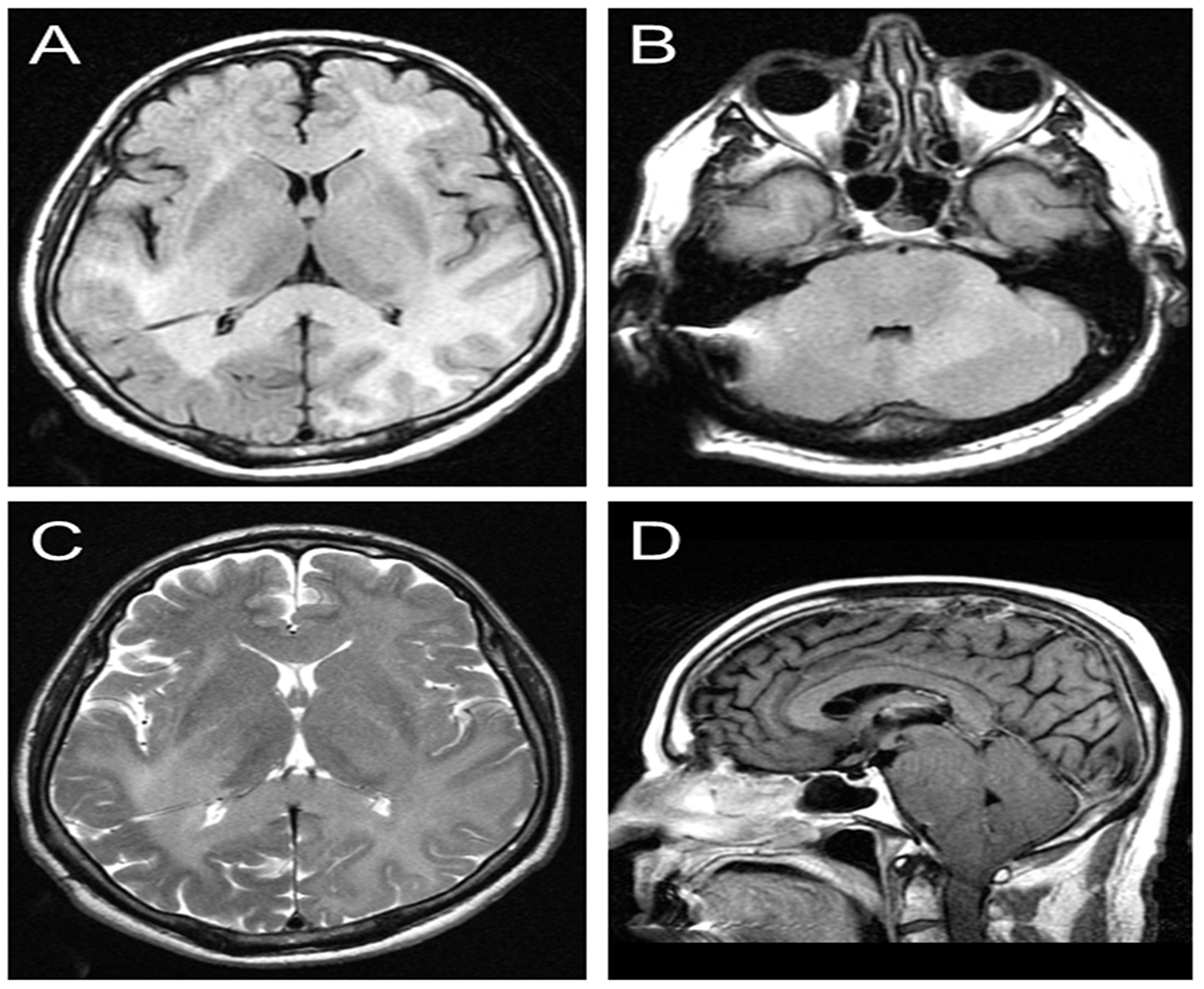 Cureus | An Indolent Presentation of Gliomatosis Cerebri in an Elderly ...