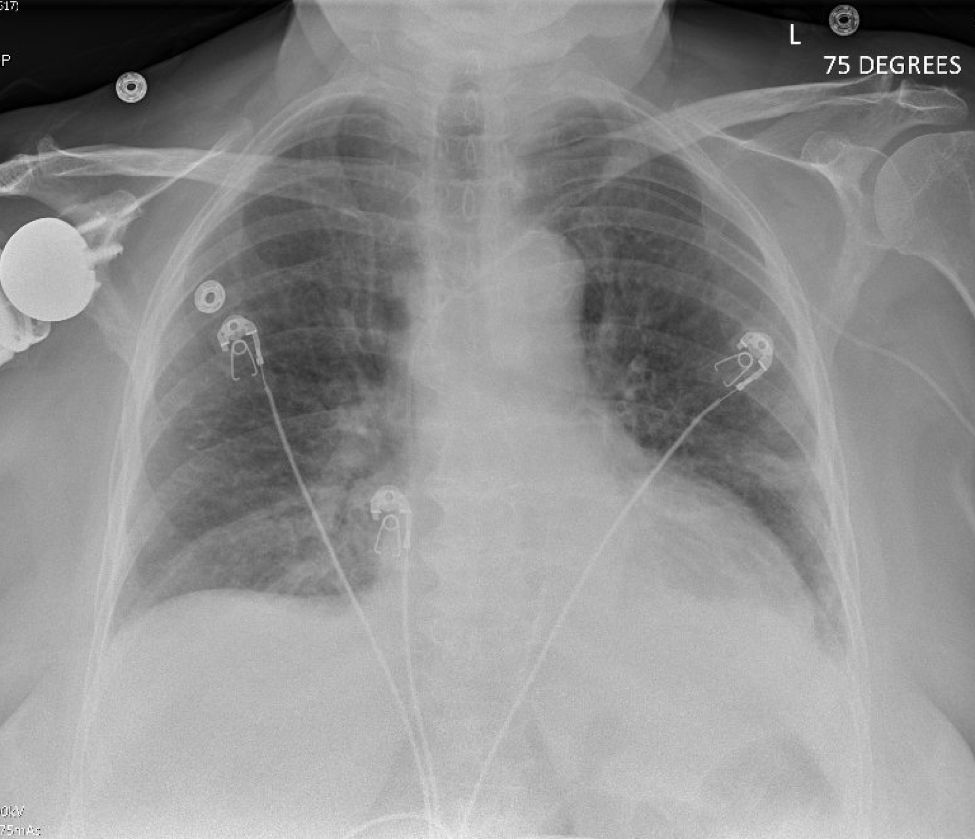 Cureus | Bortezomib Plus Melphalan-Induced Cardiomyopathy Presenting as ...