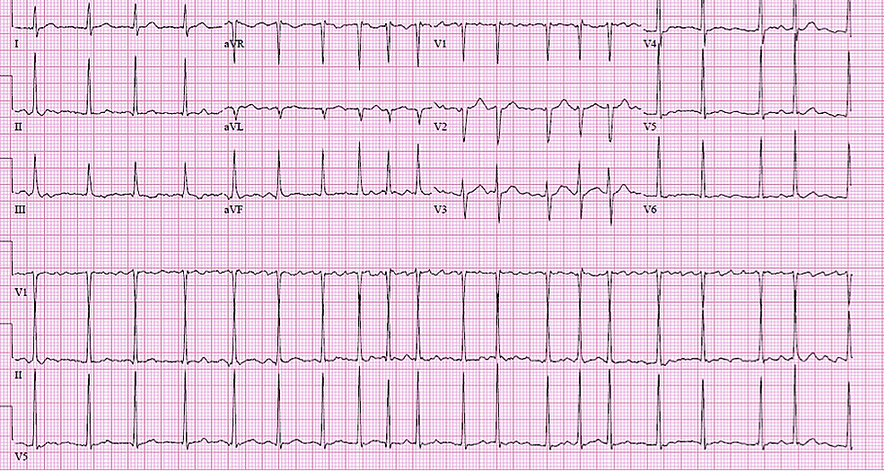 Atrial Fibrillation With Rapid Ventricular Rate Ecg E - vrogue.co