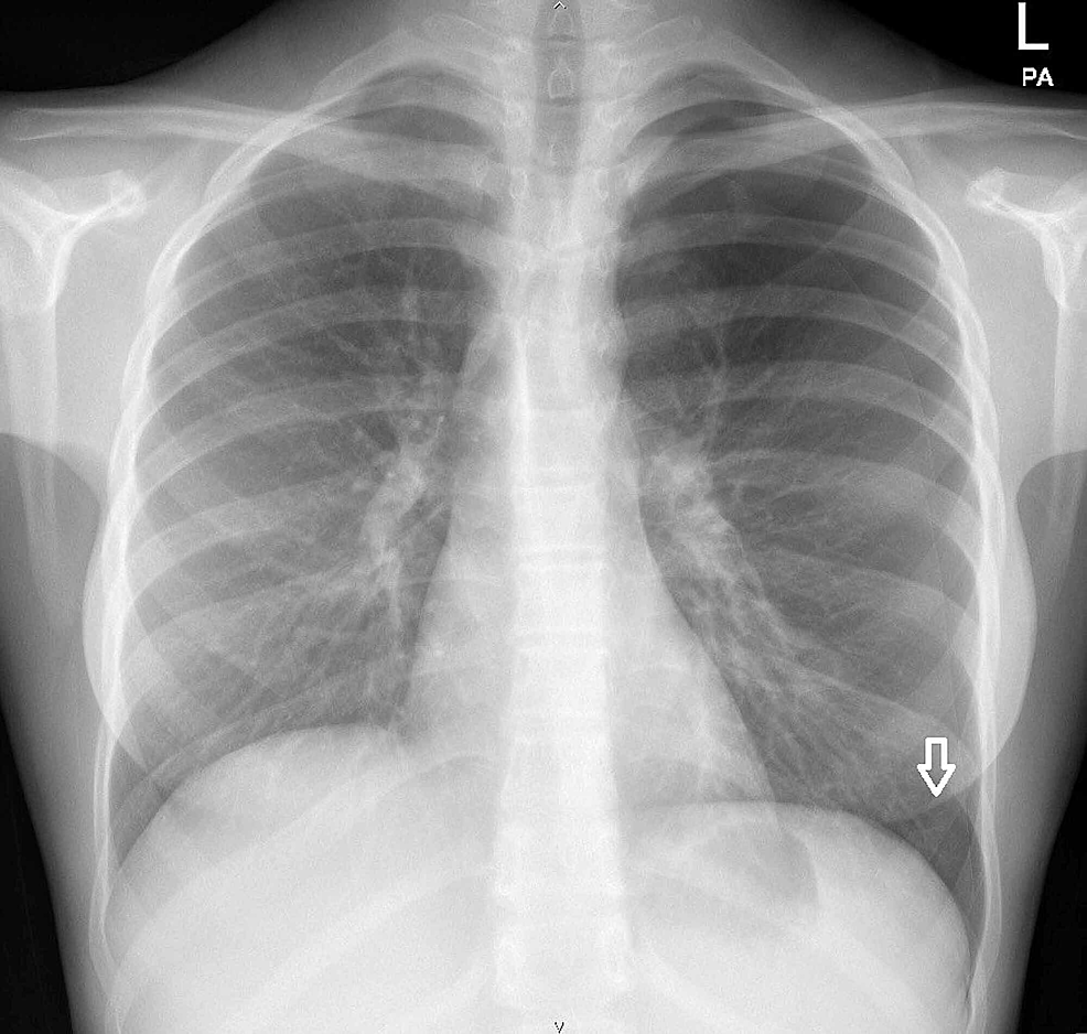 Primary Spontaneous Pneumothorax in Typhoid | Cureus