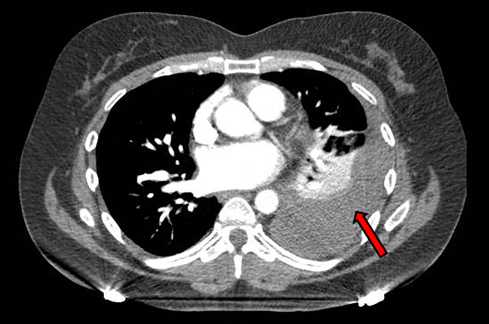 Cureus | Hemothorax After a Renal Biopsy With Ablation, a Rare ...