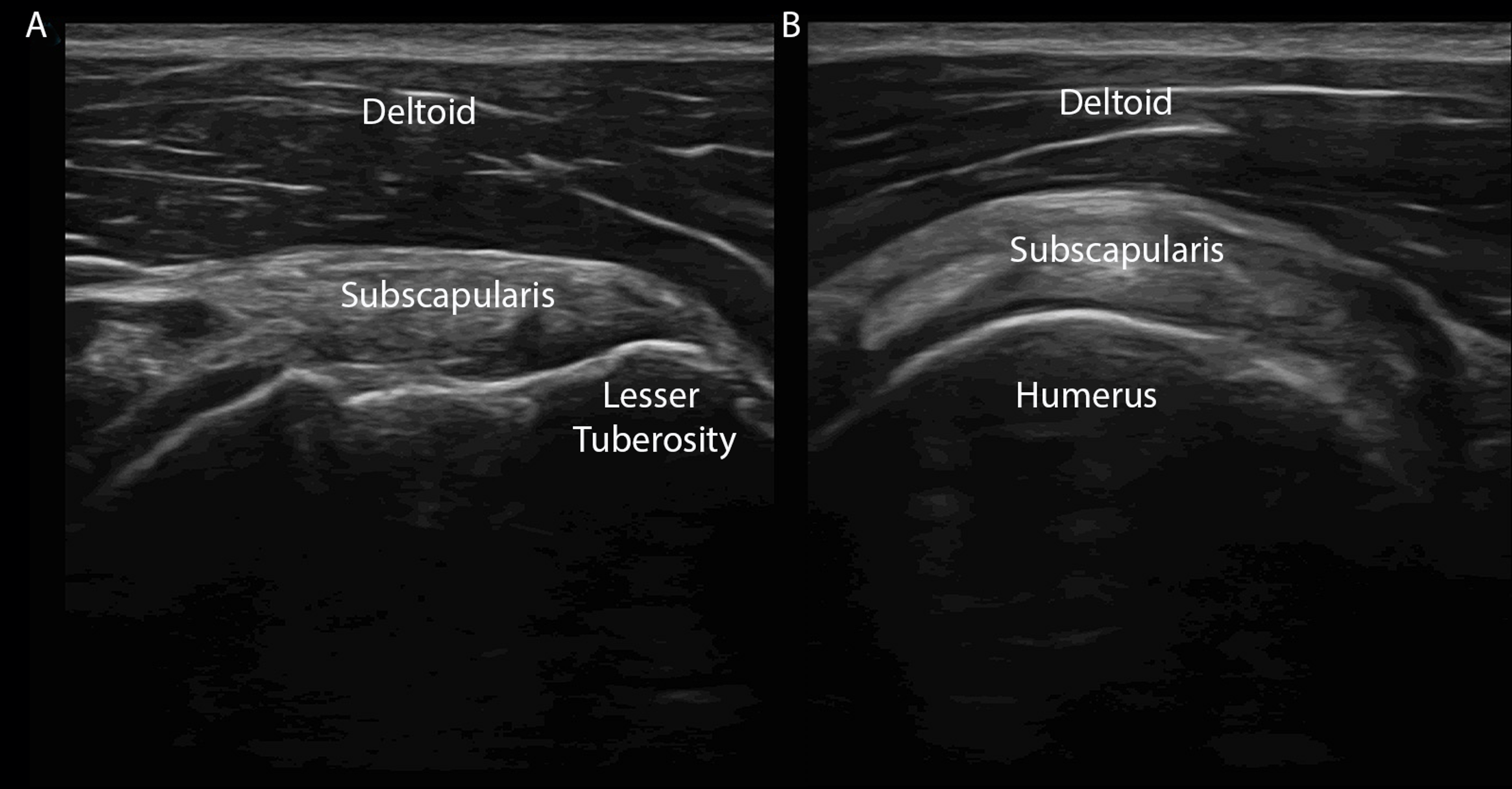 Subscapularis Ultrasound