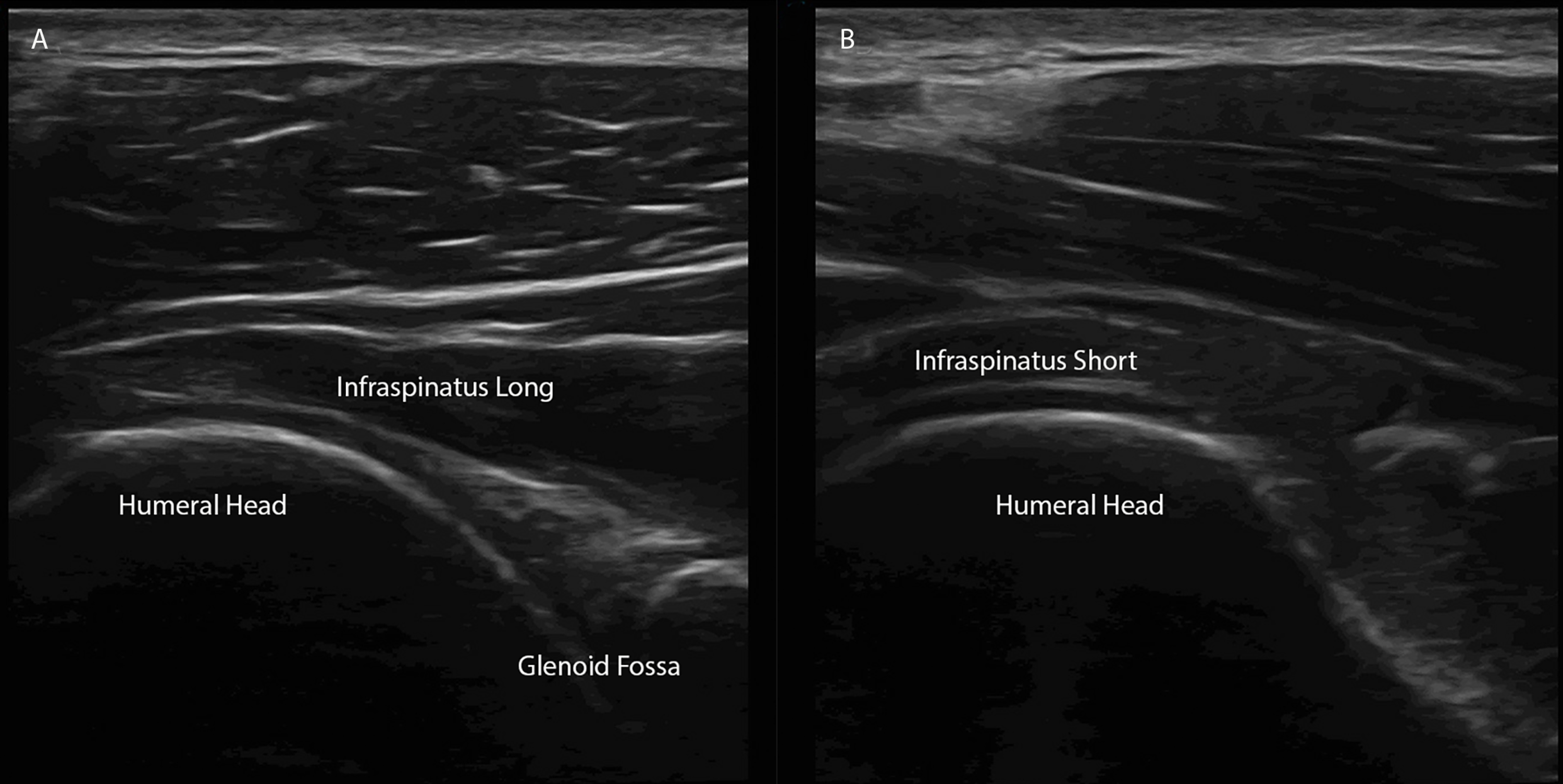 Cureus | A Stepwise Guide to Performing Shoulder Ultrasound: The ...