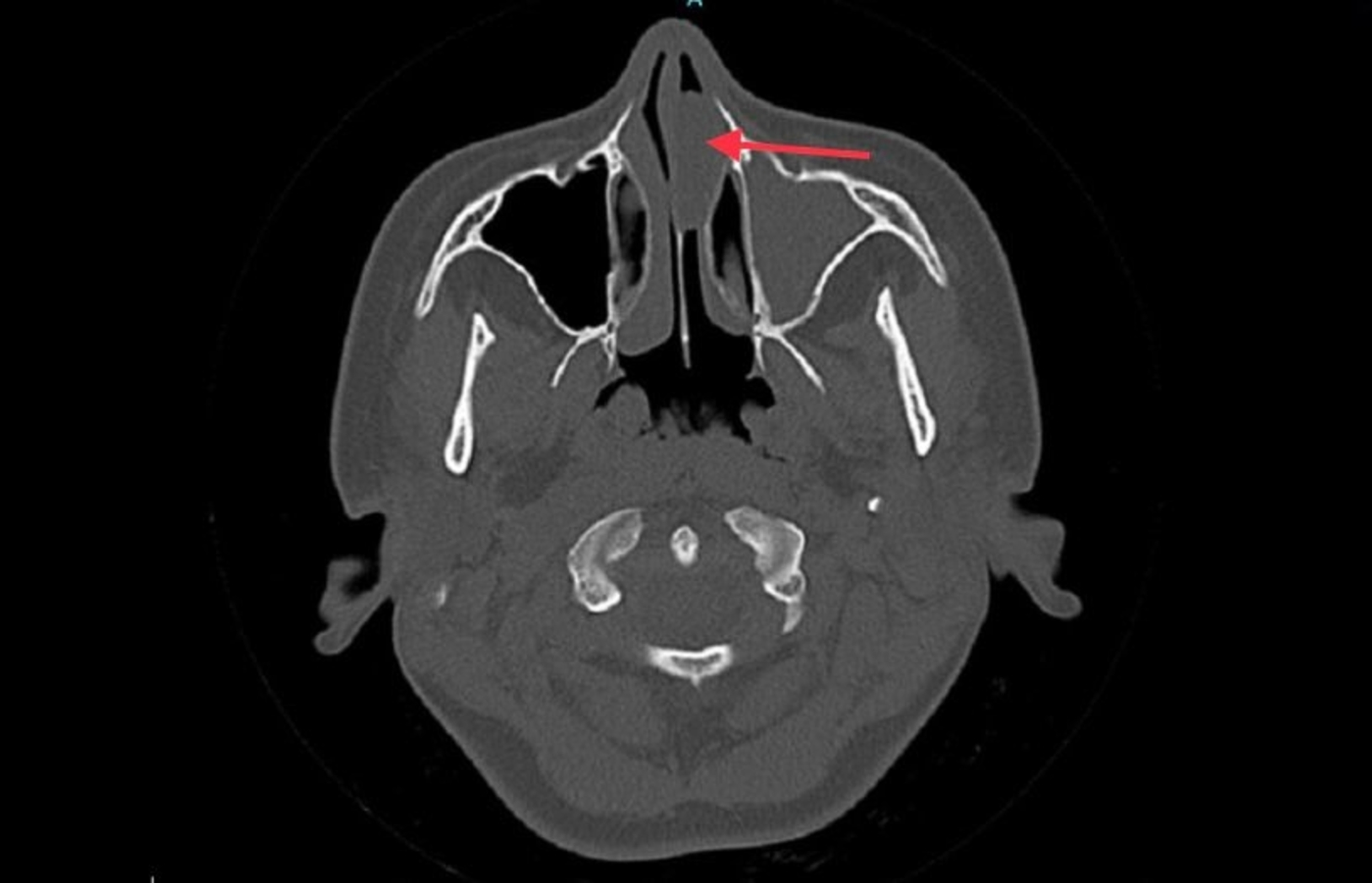 Cureus Antrochoanal Polyp In Anterior Nasal Cavity A Case Report | My ...