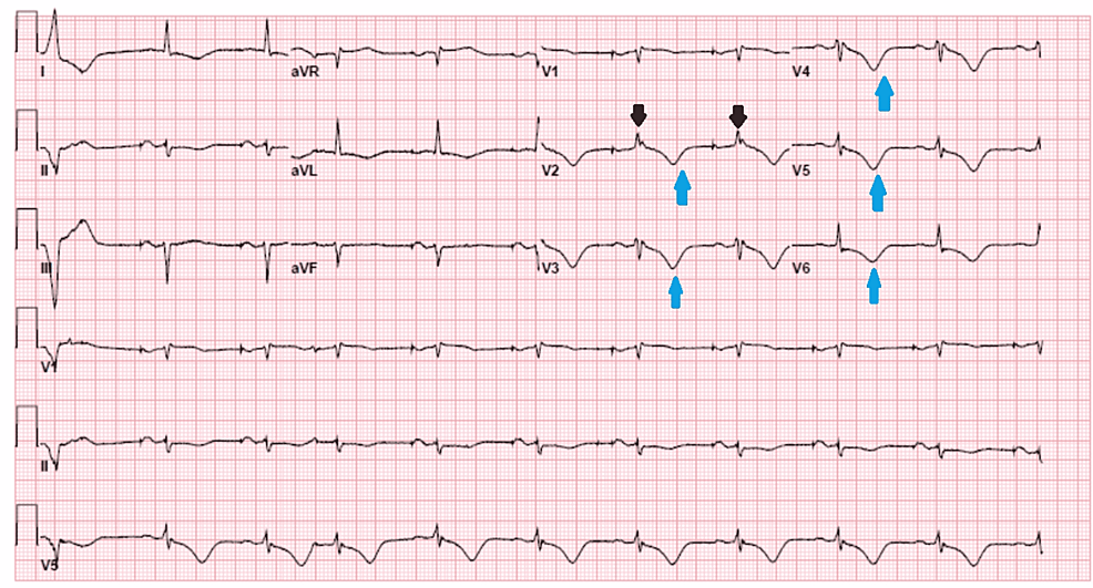 Cureus | Arrhythmogenic Right Ventricular Dysplasia (ARVD) With Protein ...