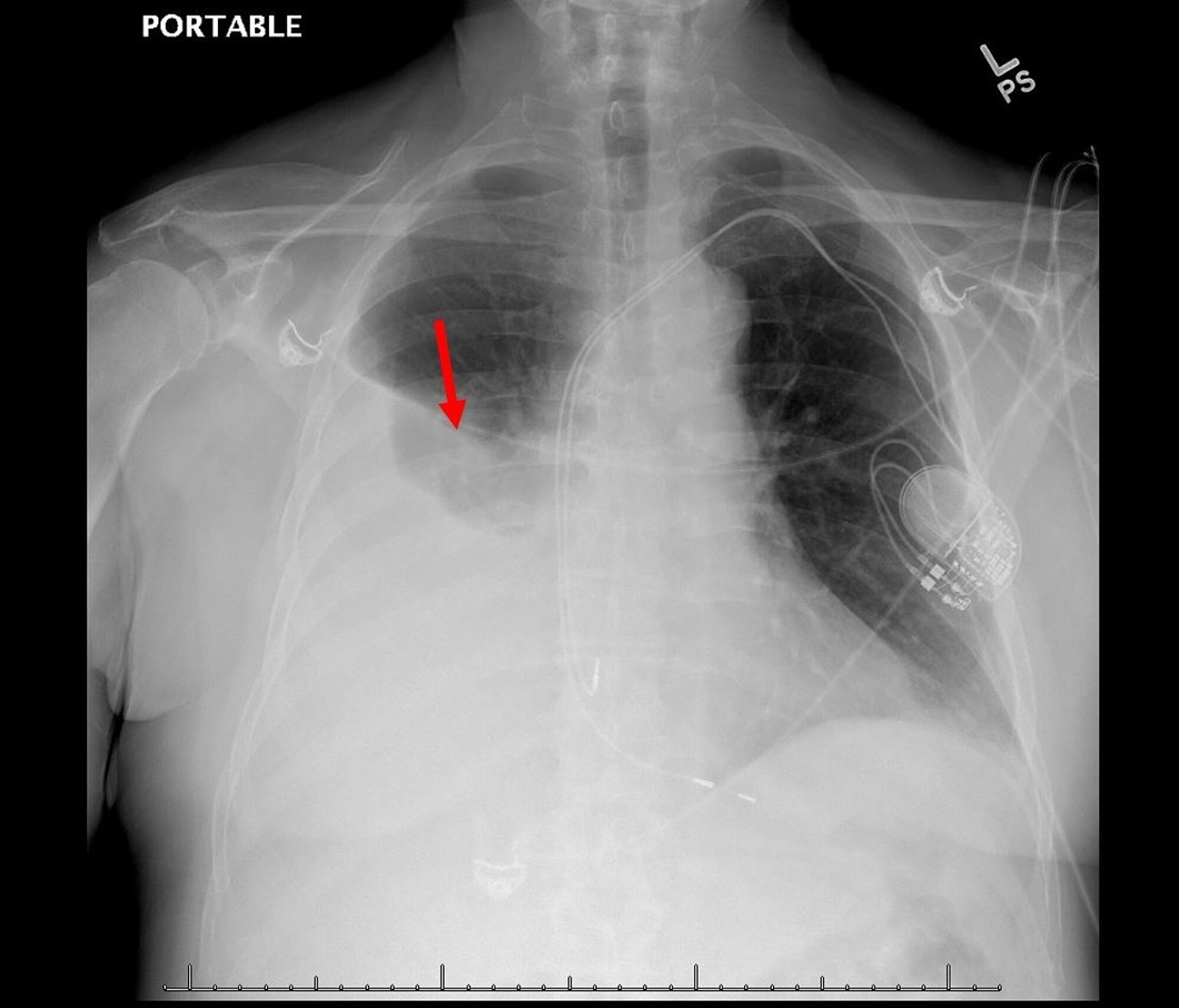 Cureus | Large Unilateral Pleural Effusion with Pacemaker-associated ...