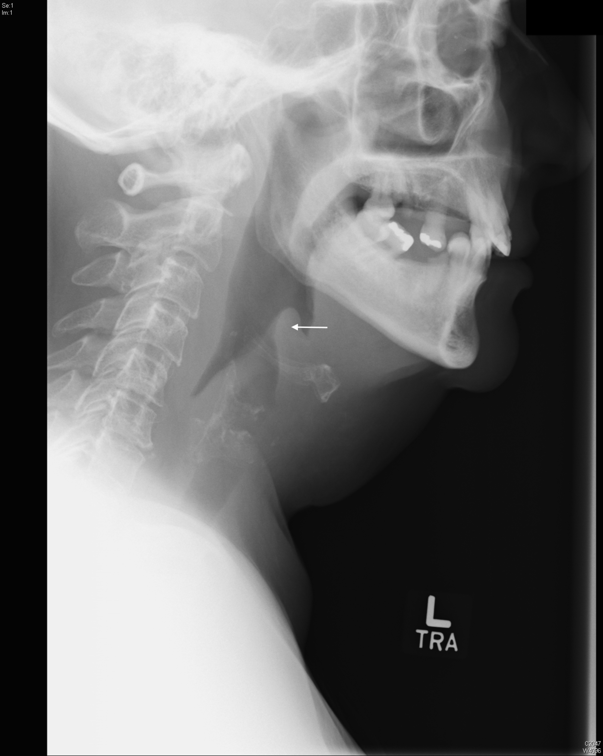 Thumb Sign Epiglottitis