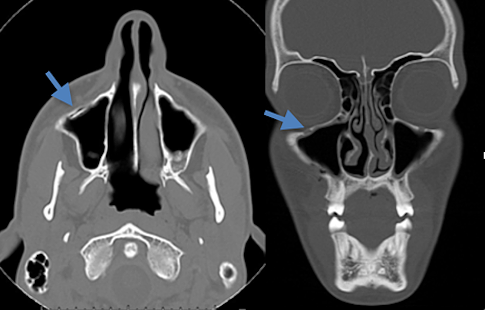 Cureus | Reevaluating the Utility of Maxillary Sinus Opacification as a ...