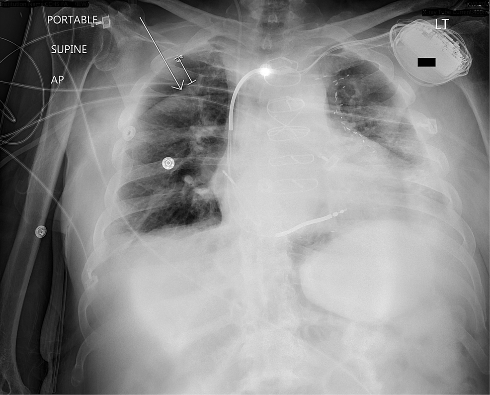 A Case of Pseudo-pneumothorax with Complications | Cureus