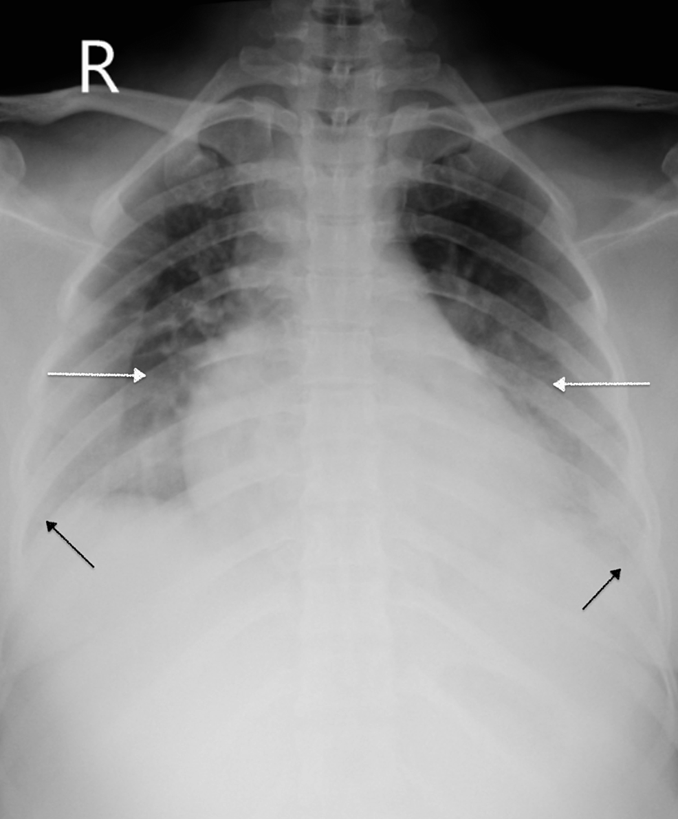 Cureus | Acute Onset Postpartum Pleural Effusion: A Near-Miss Maternal ...