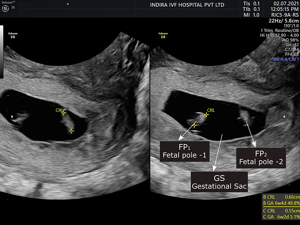 Triplet Ultrasound