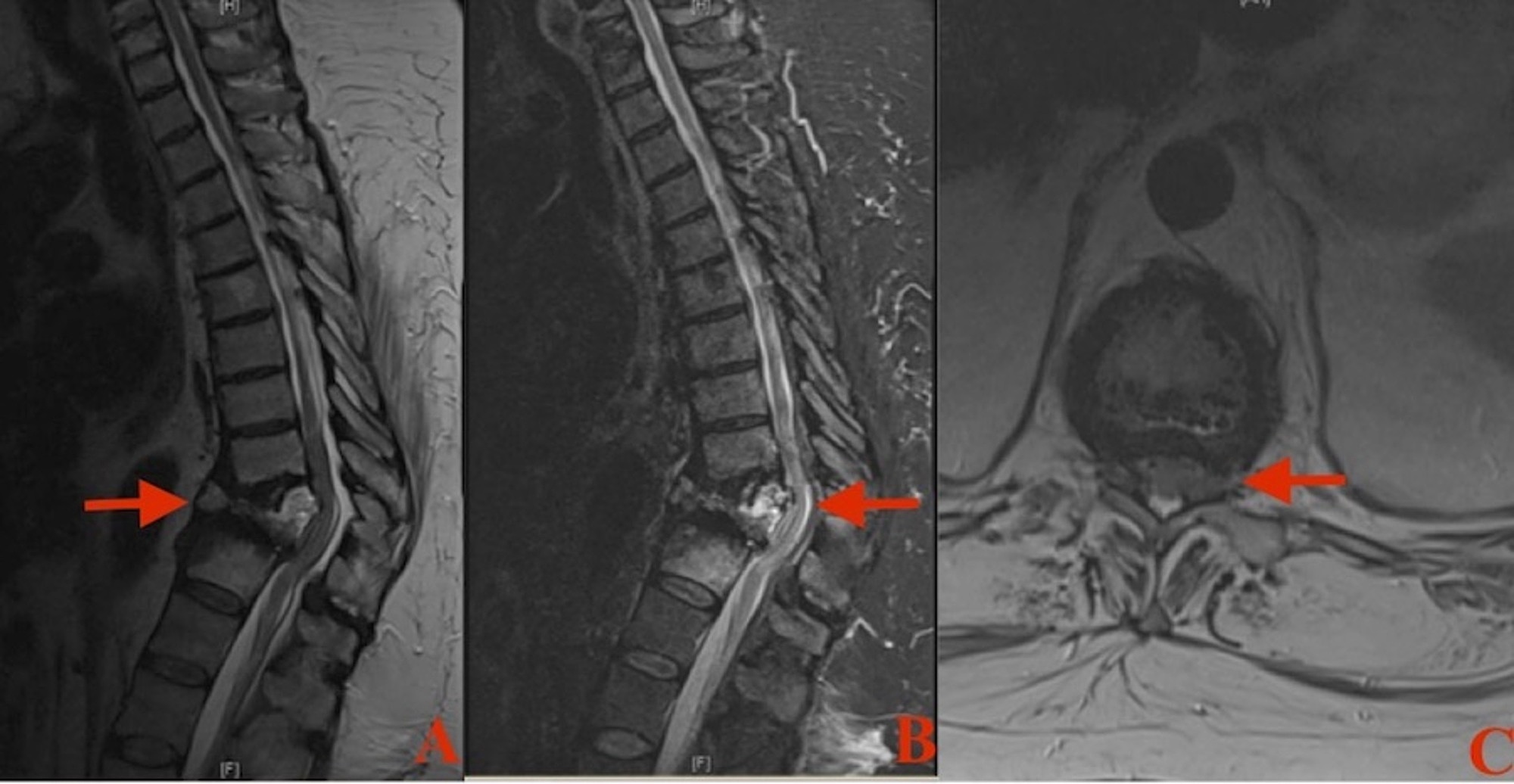 Thoracic Burst Fracture