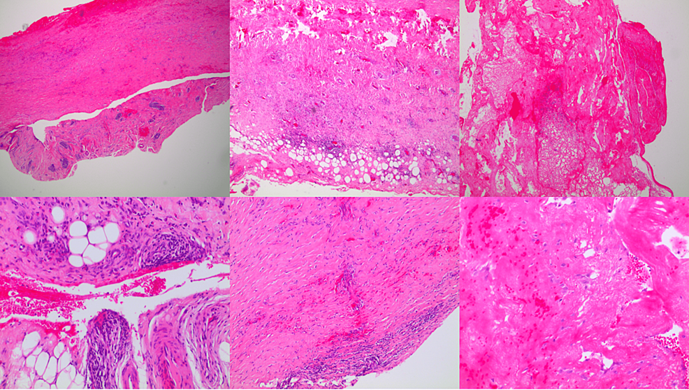 Cureus | Familial Mediterranean Fever in a 28-Year-Old Male Presented ...