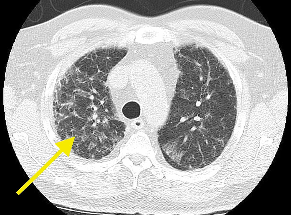 Pulmonary Fibrosis