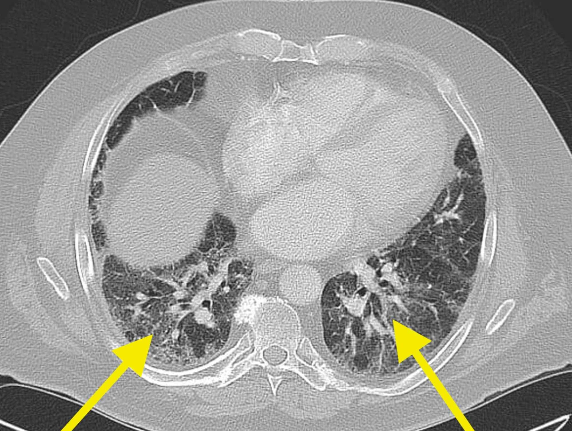 Cureus | Idiopathic Pulmonary Fibrosis: A Case of Mistaken Identity