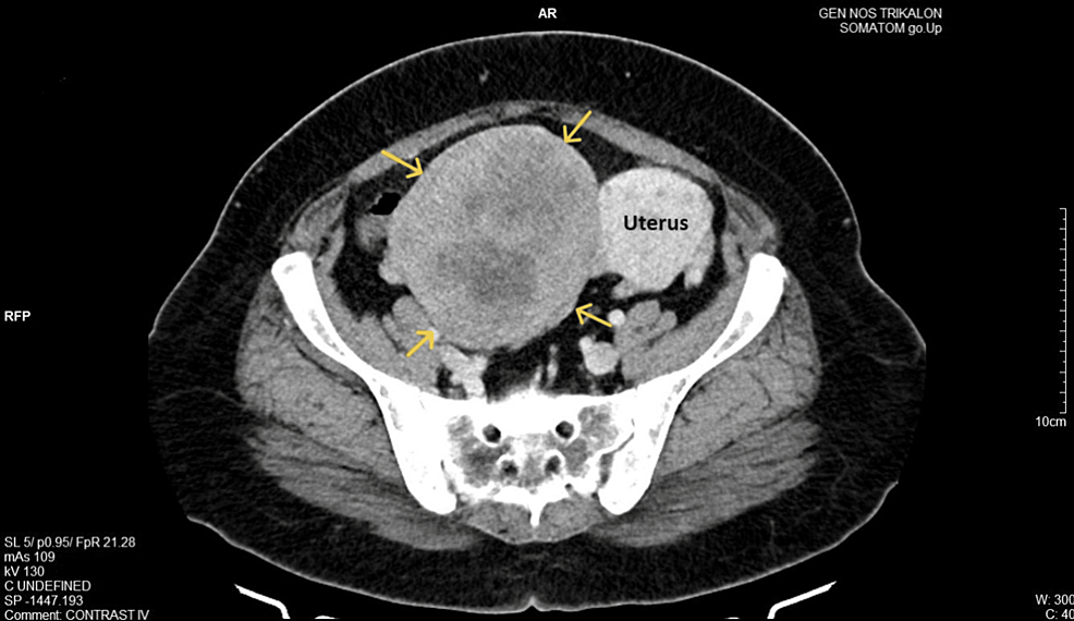 Primary Large Broad Ligament Fibroid: A Challenge in Surgical Practice ...