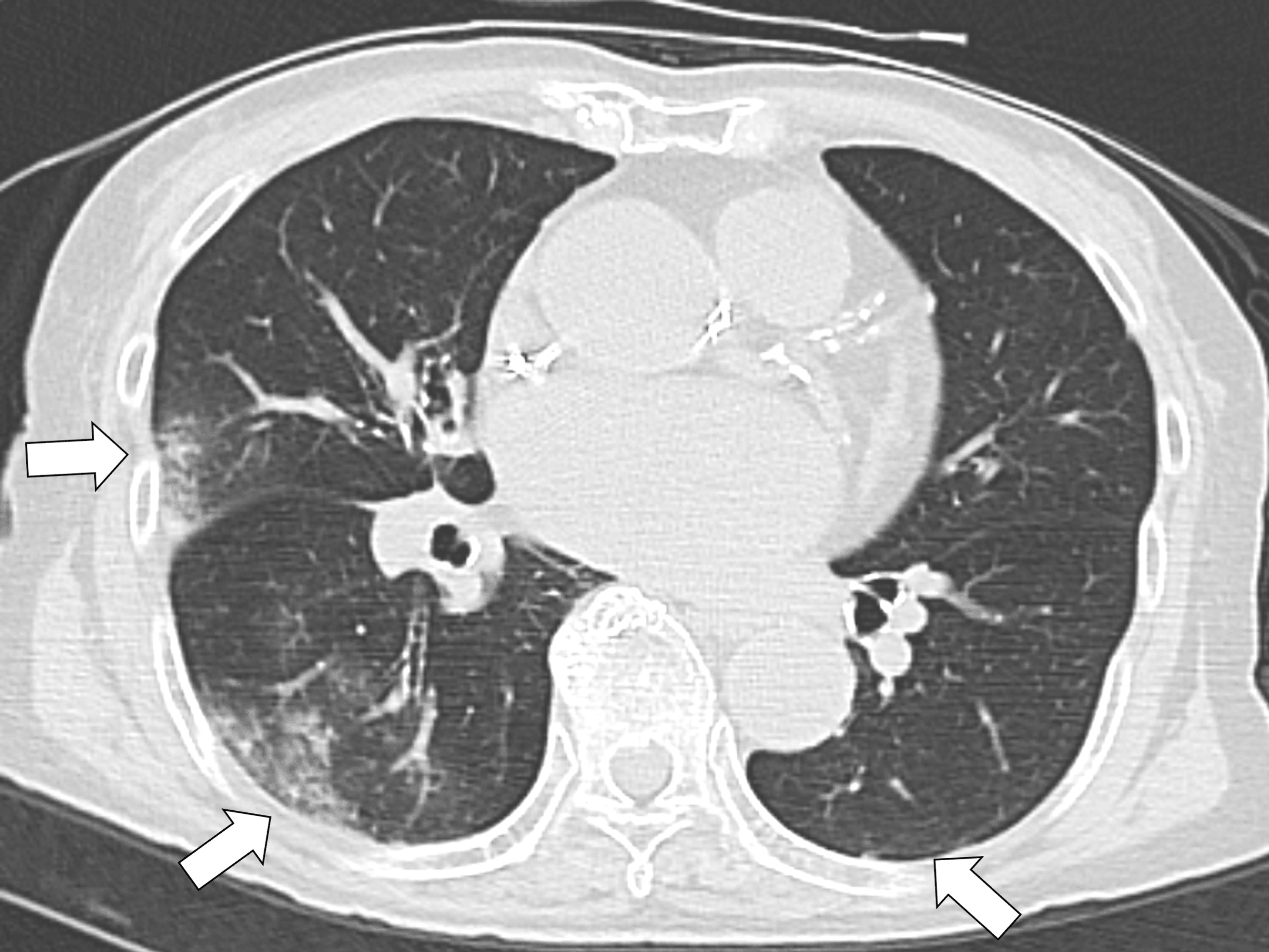 Type 2 Myocardial Infarction Caused by Orthostatic Hypotension With ...