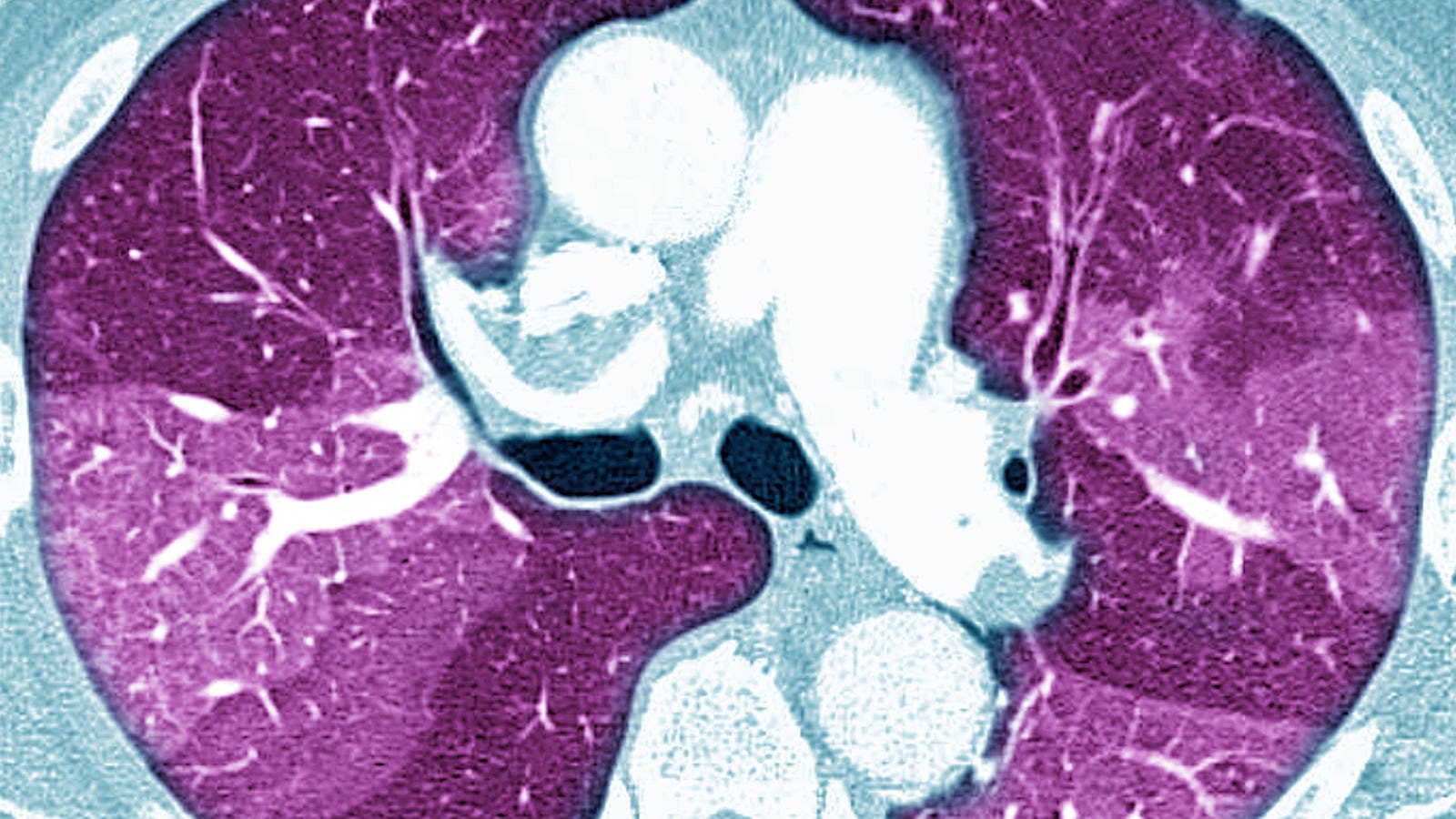 Certain Medications Tied to Post-COVID Pulmonary Fibrosis | MedPage Today