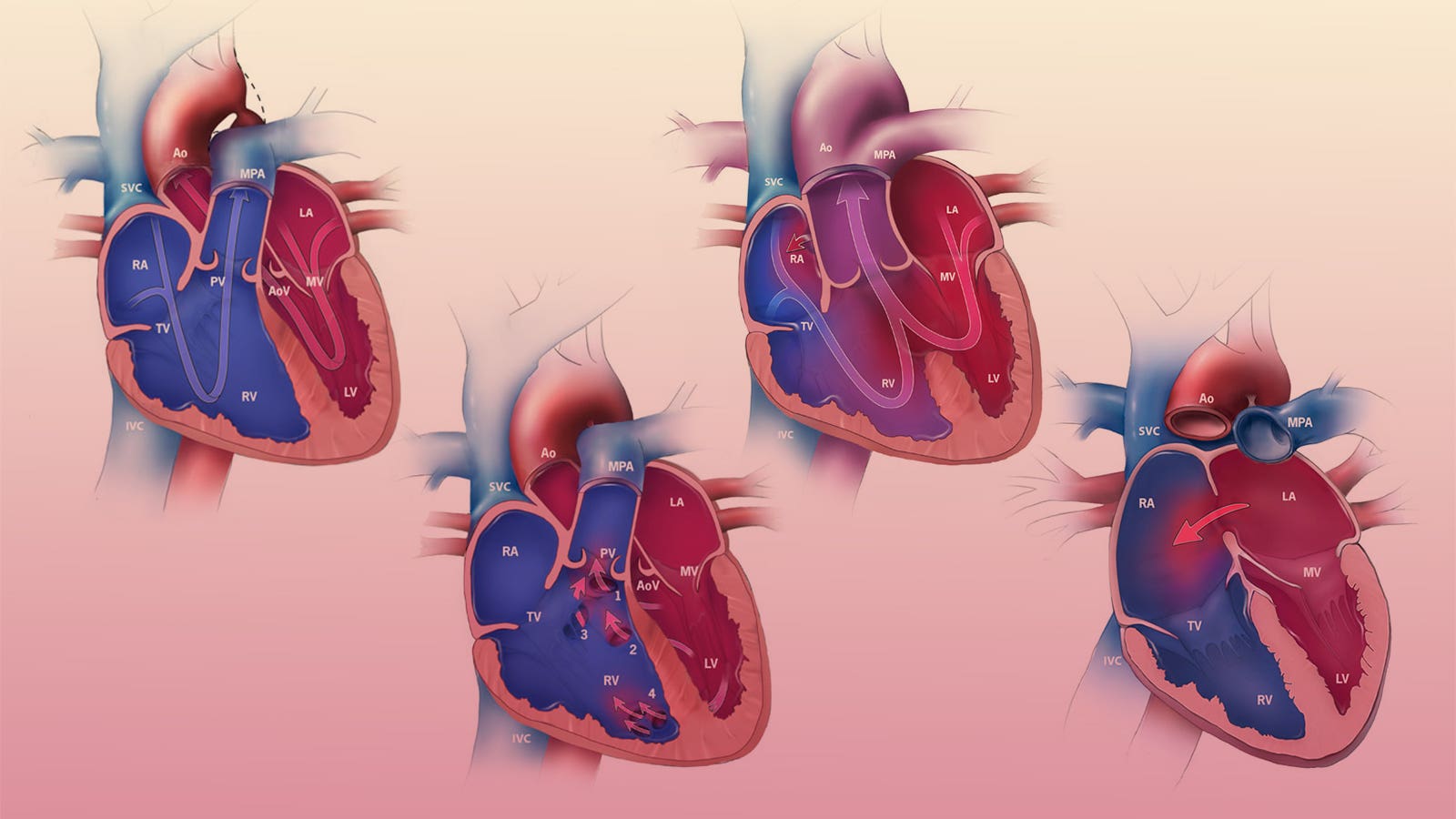 What are Congenital Heart Diseases?