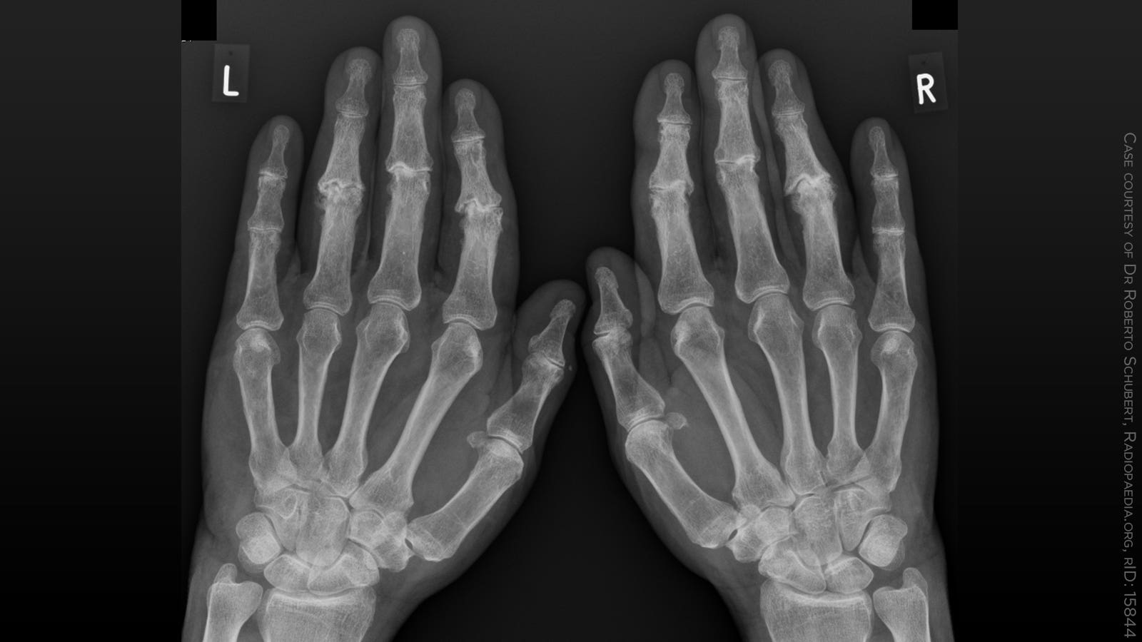 Rheumatoid Arthritis Hands X Ray