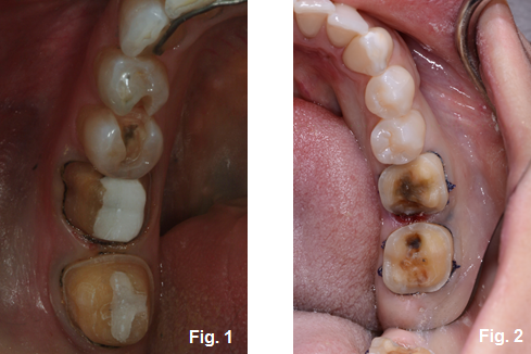 mandibular block