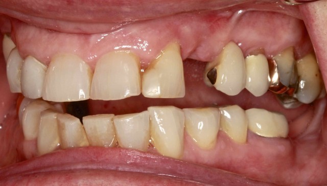 Maintaining Edentulous Spaces … Are There Consequences?