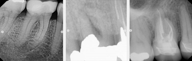 Identifying Pulpal Necrosis for Endodontic Treatment