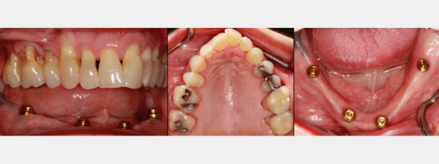 Advantages of Mandibular Locator Overdentures