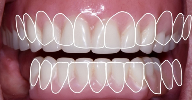 Novaloc Overdenture System: A New Approach To Low-Profile Attachments