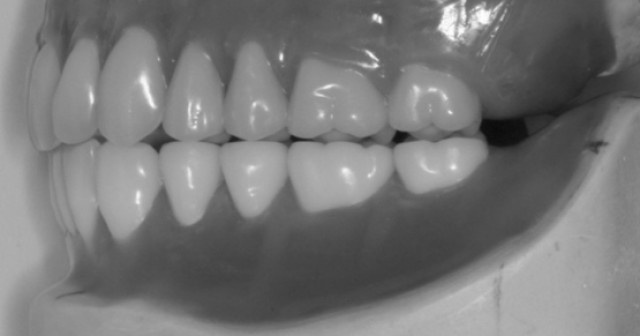 Lingualized Occlusion and the Edentulous Patient