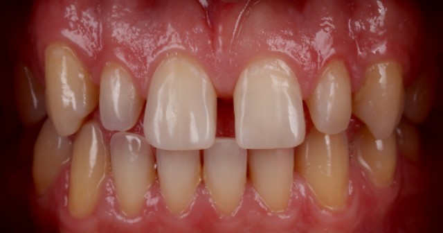 Managing the Midline Diastema Part 1: Etiology