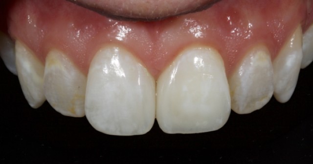 Managing the Midline Diastema Part 3: The Restoration