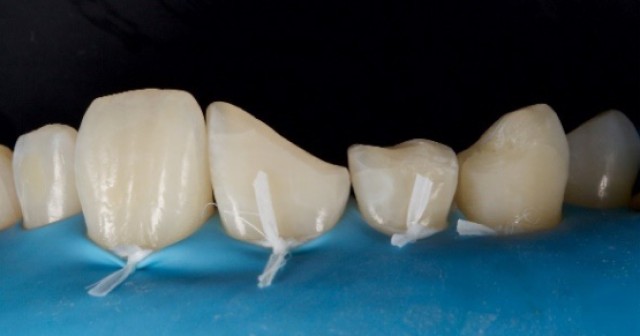 Rubber Dam in Dental Procedures Part 3: Preparing Your Armamentarium