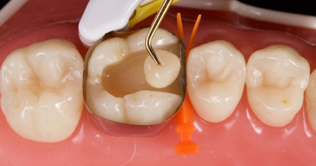 Reducing Sensitivity in Class II Direct Resin Restorations