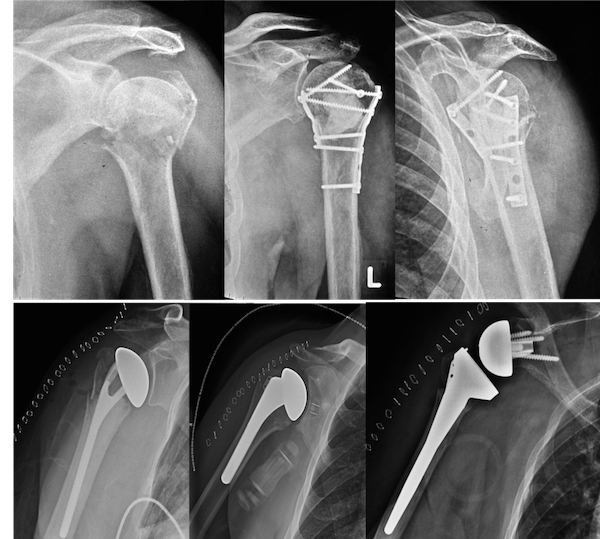 Proximal humerus fracture - tatkanic