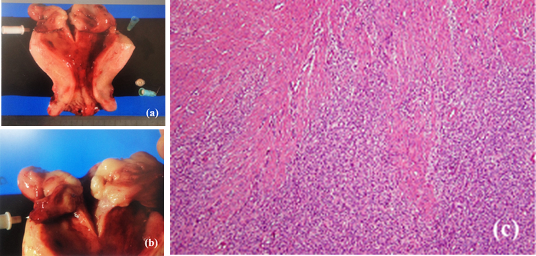 Low-Grade Endometrial Stromal Sarcoma Which Relapsed a Month after ...