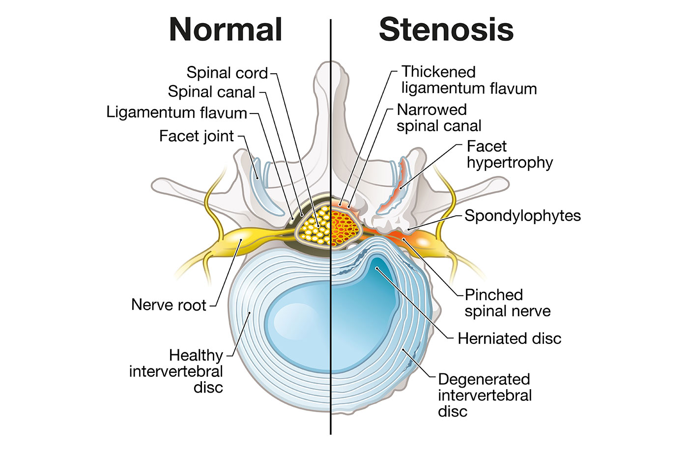 Lumbar Stenosis: Causes, Symptoms and Treatment Options for Narrowing ...