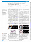 Research paper thumbnail of Atypical morphological variants of congenital cataract in Down’s syndrome