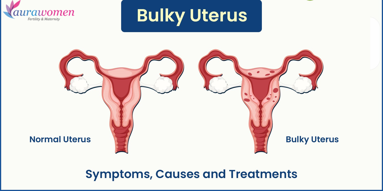 Bulky Uterus: Its Symptoms, Causes and Treatments | Aurawomen