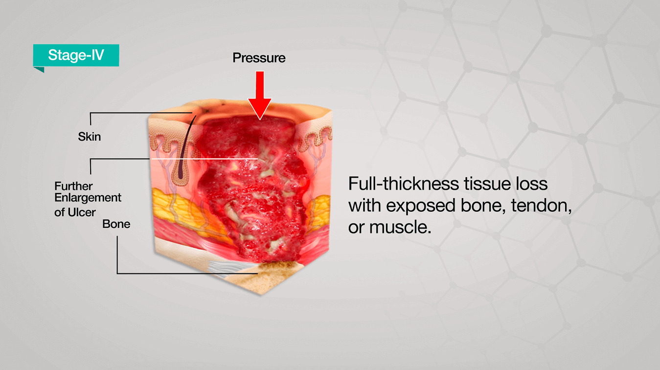 Skin Pressure Ulcer Stages