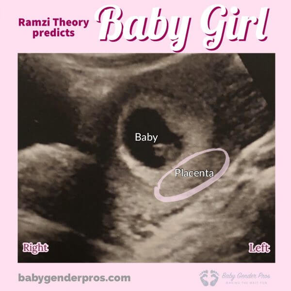 Ramzi theory 6 week ultrasound 