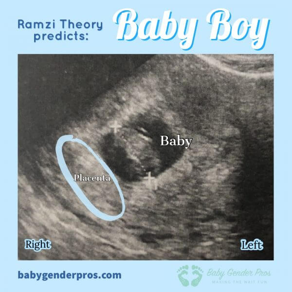 ramzi theory 7 week ultrasound